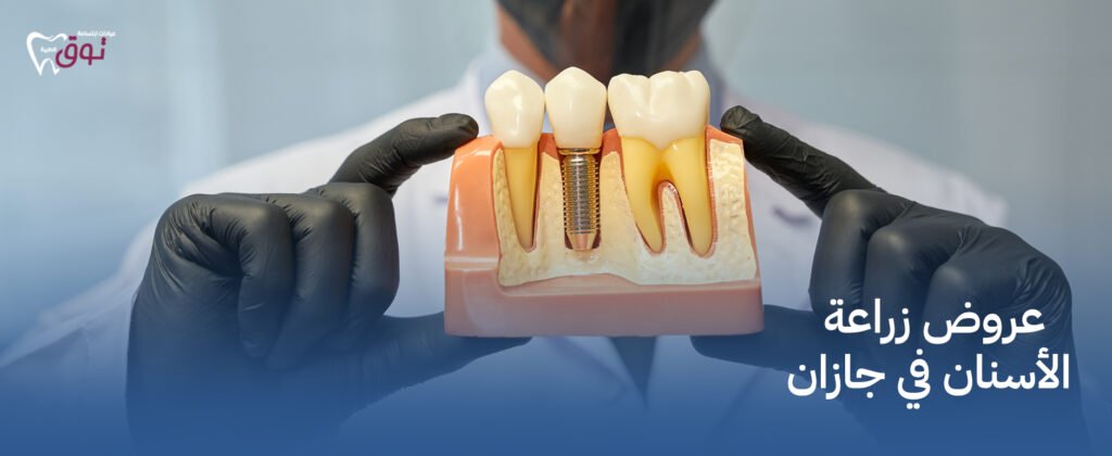 عروض زراعة الأسنان في جازان  – احصل على ابتسامة جديدة بأسعار مميزة