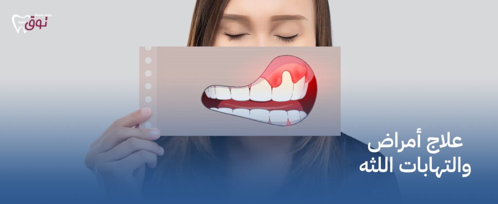علاج أمراض والتهابات اللثه بطريقة فعالة