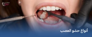 أنواع حشو العصب – اختَر الأفضل لعلاج أسنانك الآن