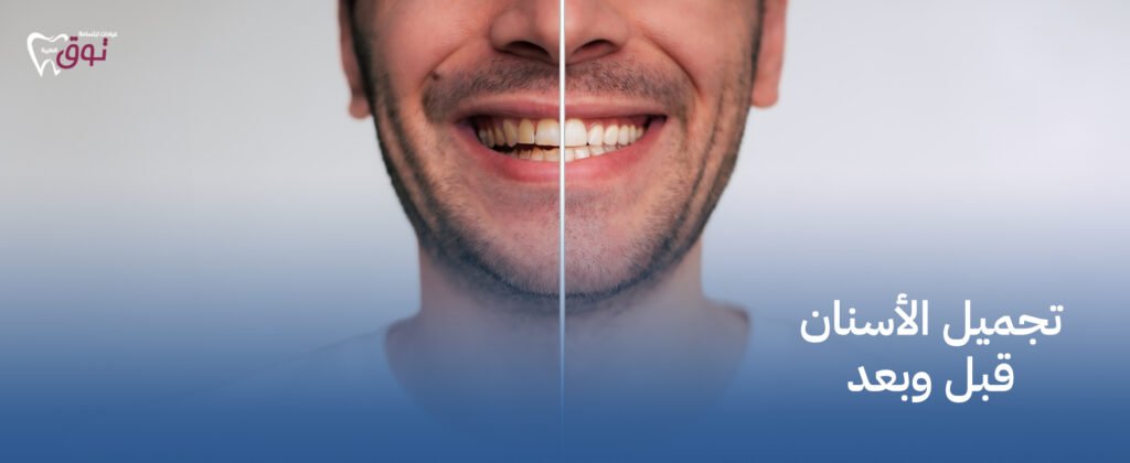 تجميل الأسنان قبل وبعد | نتائج مذهلة وتحول جذري