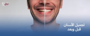 تجميل الأسنان قبل وبعد | نتائج مذهلة وتحول جذري