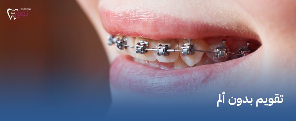 تقويم بدون ألم في عيادات توق | راحة تامة أثناء العلاج