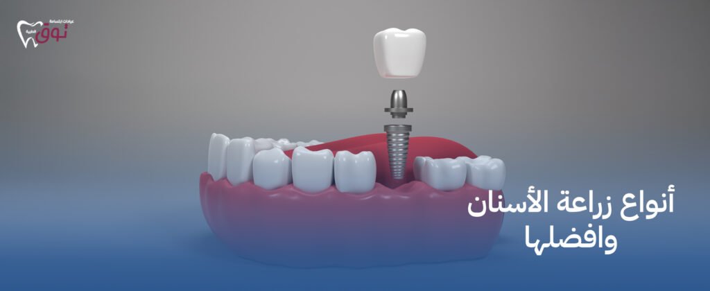 أنواع زراعة الأسنان وافضلها | أحدث طرق زراعة الأسنان